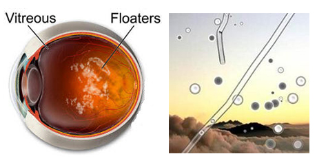 floaters